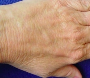 Radiesse hand rejuvenation