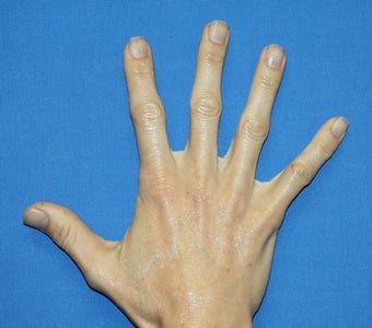 Filler in Hands