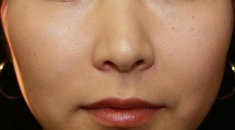 Injectable Filler