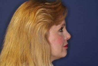 Radiesse