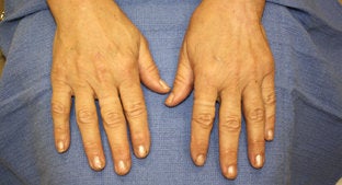 Radiesse Hands 