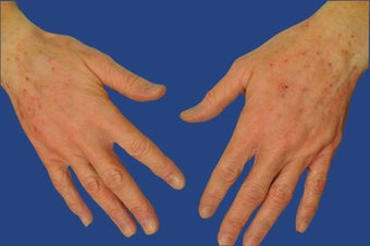 Dermal Filler for Hand Rejuvenation