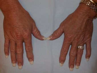 Before & After Hand Rejuvenation