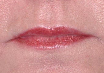 Radiesse and Restylane for Marionette Lines and Lips