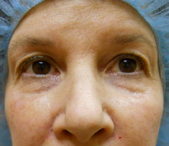 Under-Eye Filler Treatment