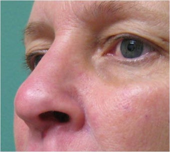 Radiesse on nose