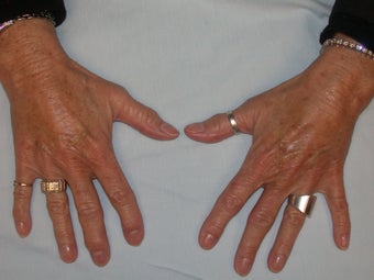 Hand Rejuevnation with Radiesse