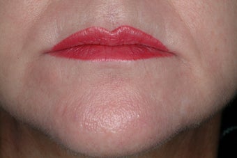 Radiesse and Botox