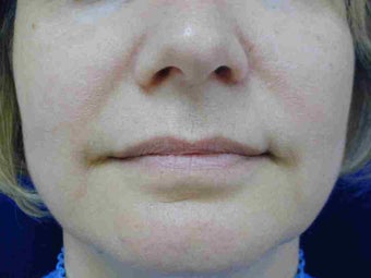 Radiesse treatment 