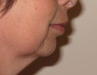 Injectables  
