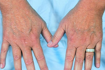 Radiesse for Hand Rejuvenation