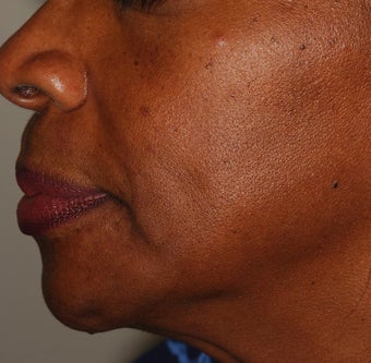 Radiesse Treatment
