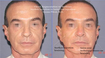 Cheek Augmentation with Radiesse