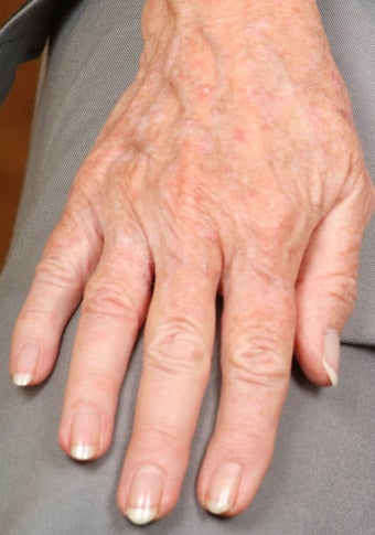 Radiesse treatment for hand rejuvenation