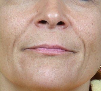 Radiesse treatment for nasolabial folds