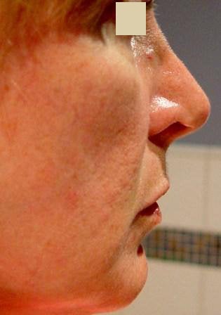 Radiesse Cheek Lift 