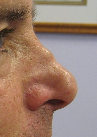 Filler Nose Job