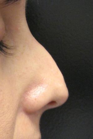 Nasal Tip created using Radiesse