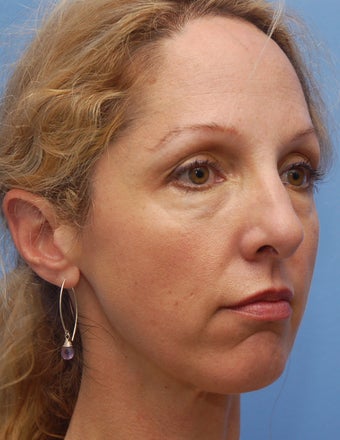 Cheek Dermafillers, Eye Dermafillers, Facial Dermafillers