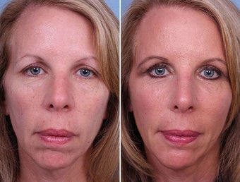 Radiesse, Cheek and Chin Augmentation