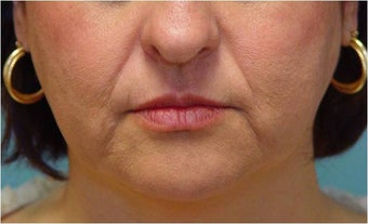 Radiesse injection nasolabial folds and marionette lines