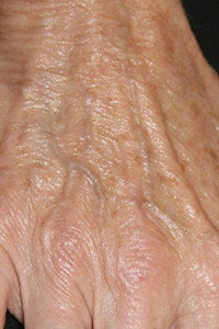 Radiesse hand injection