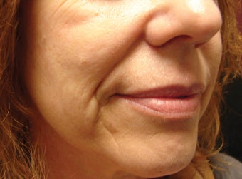 Radiesse Injection into the Cheeks and Nasolabial Folds