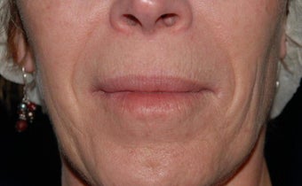 Nasolabial fold correction