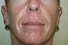 Radiesse and Juvederm XC