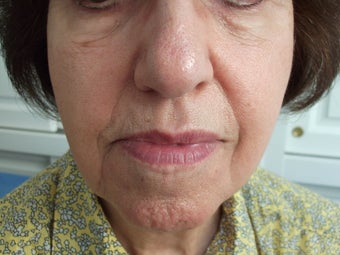 Radiesse to the face/ nasolabial folds