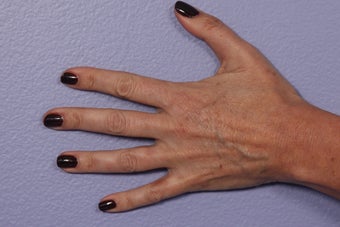 Radiesse to Hands