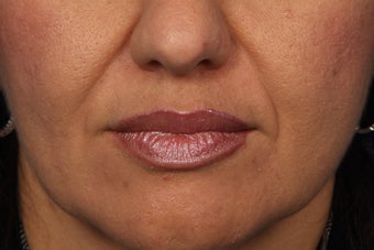 Radiesse to Smile Lines (nasolabial folds)