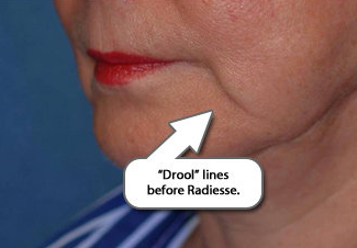 Radiesse Augmentation of the Marionette Line