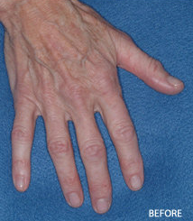 Radiesse Filler Augmentation of the Hands