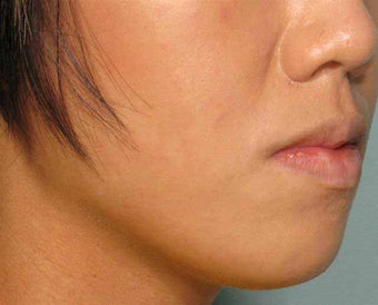Radiesse in the chin