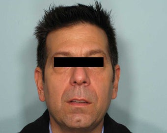 The Liquid Facelift for a Man