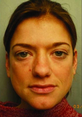 Radiesse injections