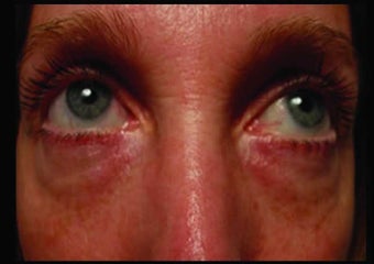 Radiesse under the eyes