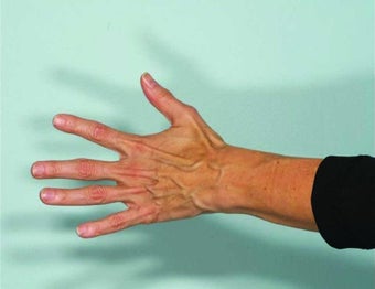 Radiesse hand rejuvenation