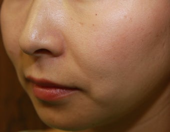 Radiesse Chin Implant / Augmentation