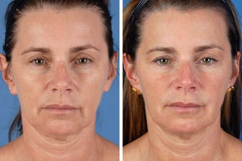 Radiesse & Botox Cosmetic