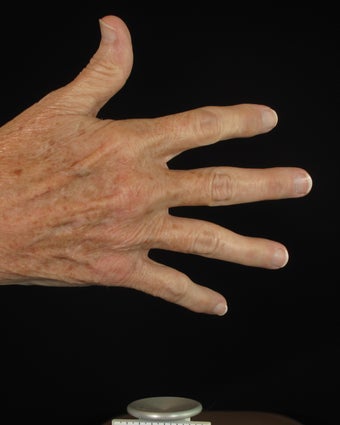 Hand Rejuvenation 
