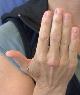 Radiesse Hand Rejuvenation 