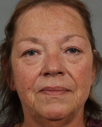 Radiesse & Juvederm