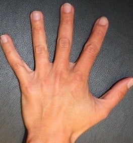 Hand rejuvenation