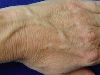 Radiesse hand rejuvenation