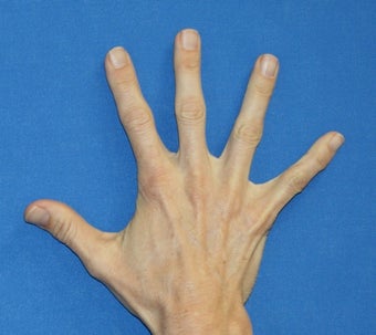 Filler in Hands