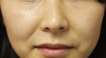 Injectable Filler