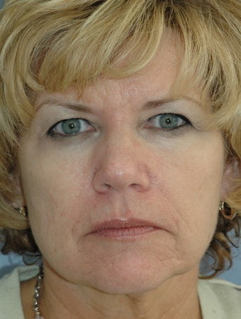 Botox and Fillers