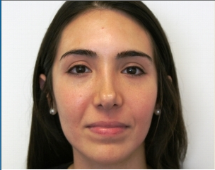 Facial Rejuvenation with Soft tissue fillers